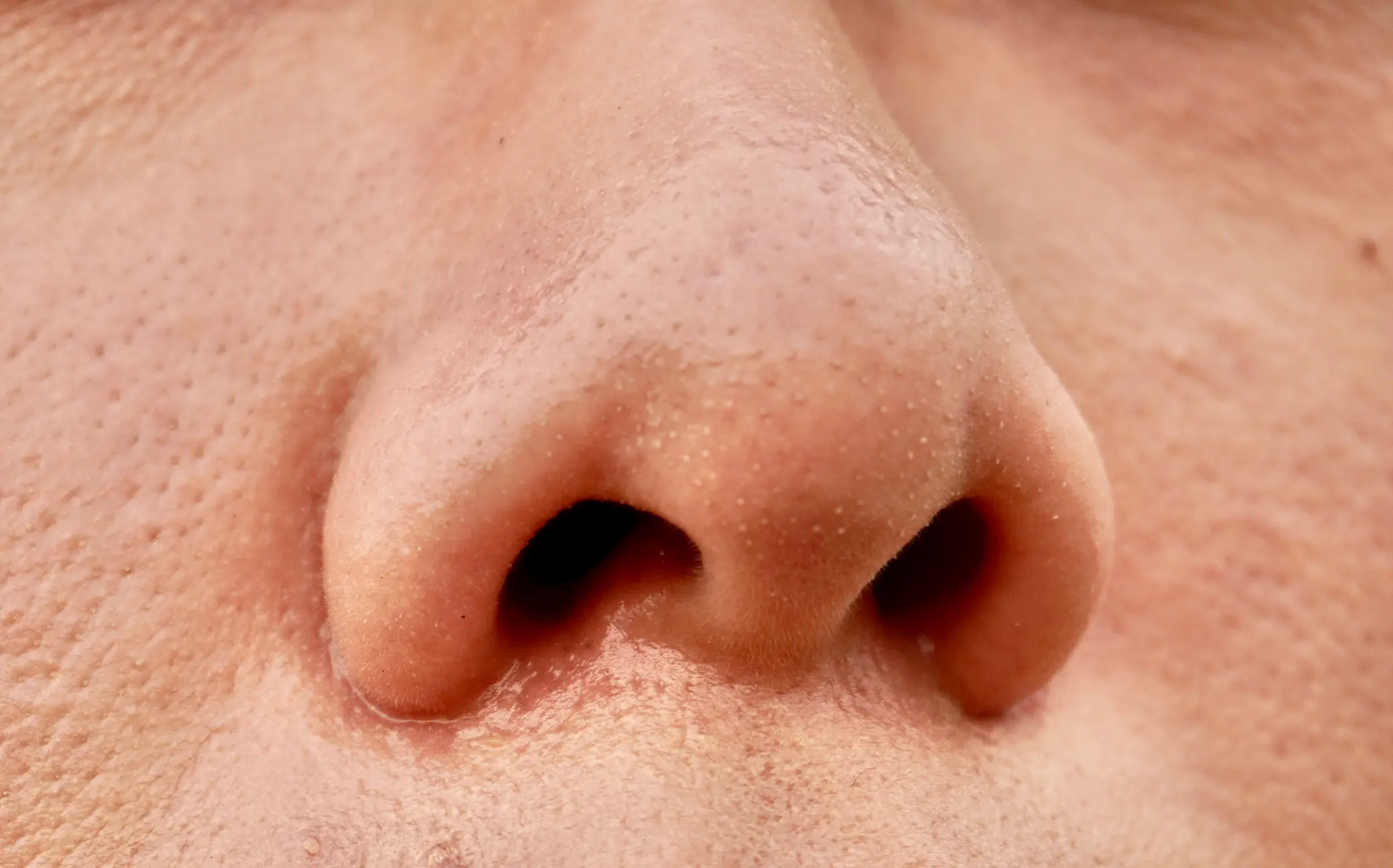 How to Remove Blackheads